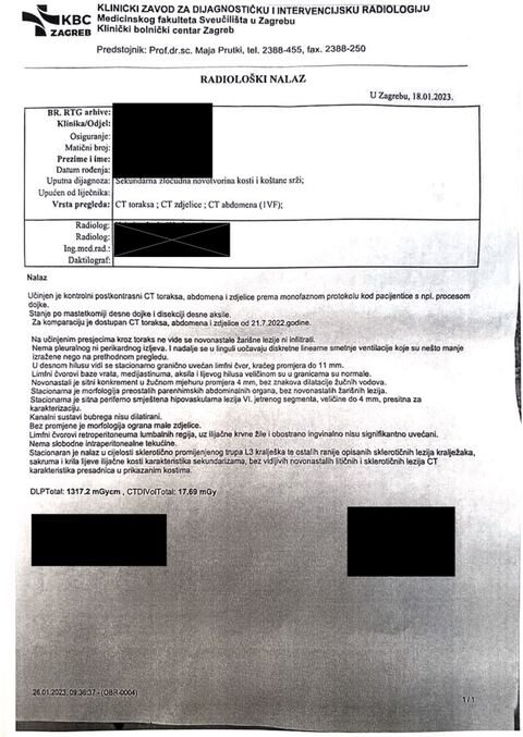 Nalaz — Sekundarna zloćudna novotvorina kosti i koštane srži (anonimizirano)